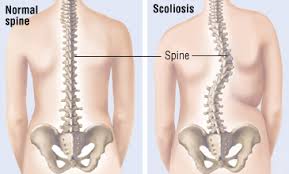 Scoliosis Pain