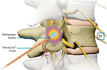 RadioFrequency- For back pain