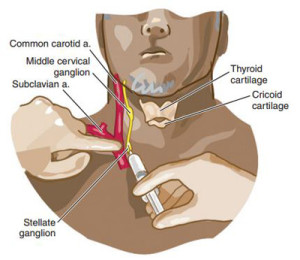 Stellate Ganglion Block Injections