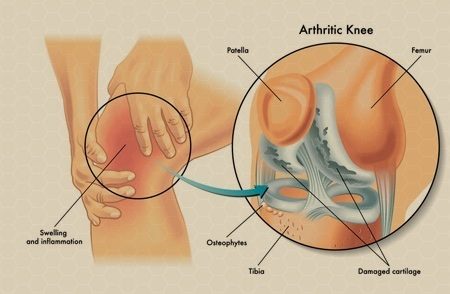 Orthovisc Knee Injections