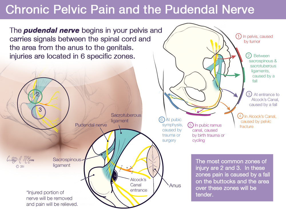 A Guide to Pudendal Neuralgia: Symptoms, Causes and Treatment Options