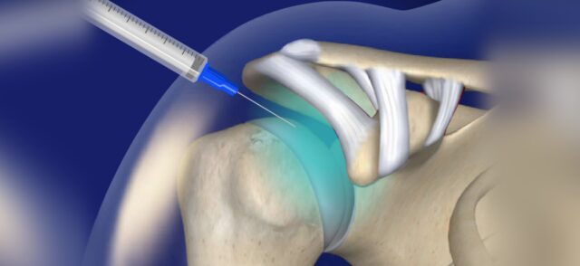 Steroid Injection for Joint Pain