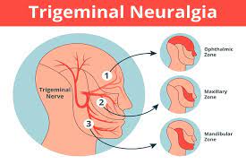 What Is Trigeminal Neuralgia - Steven B. Syrop, DDS Briarcliff Manor, NY  Dentist
